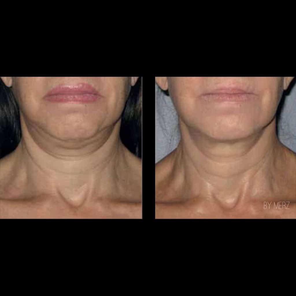 neck treatments perth