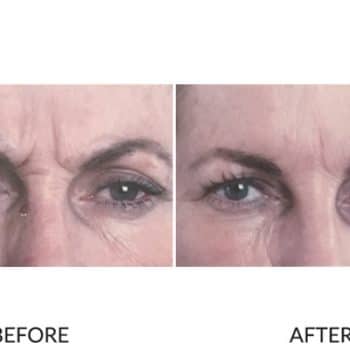 Effective result of anti wrinkle treatment in frown lines.