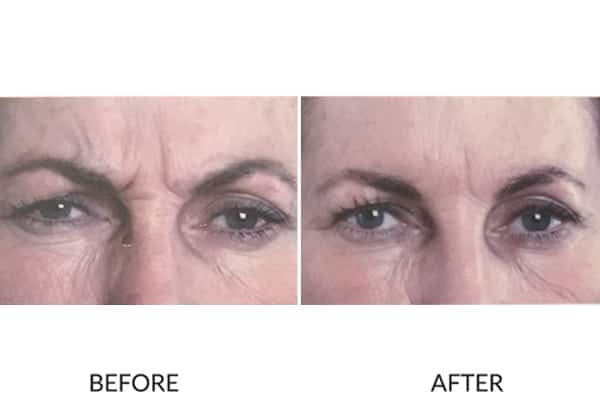 Effective result of anti wrinkle treatment in frown lines.
