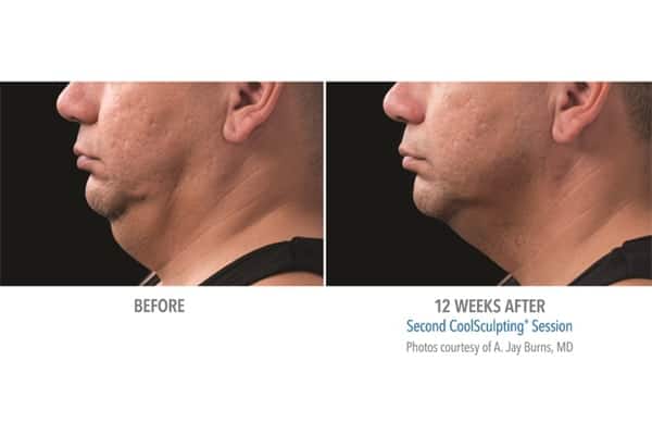 double chin removal non surgical