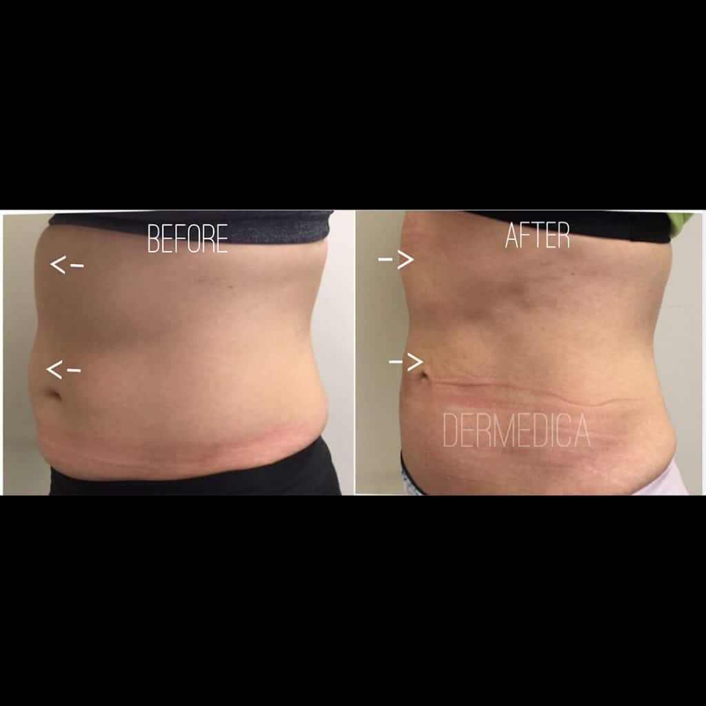 stomach fat removal
