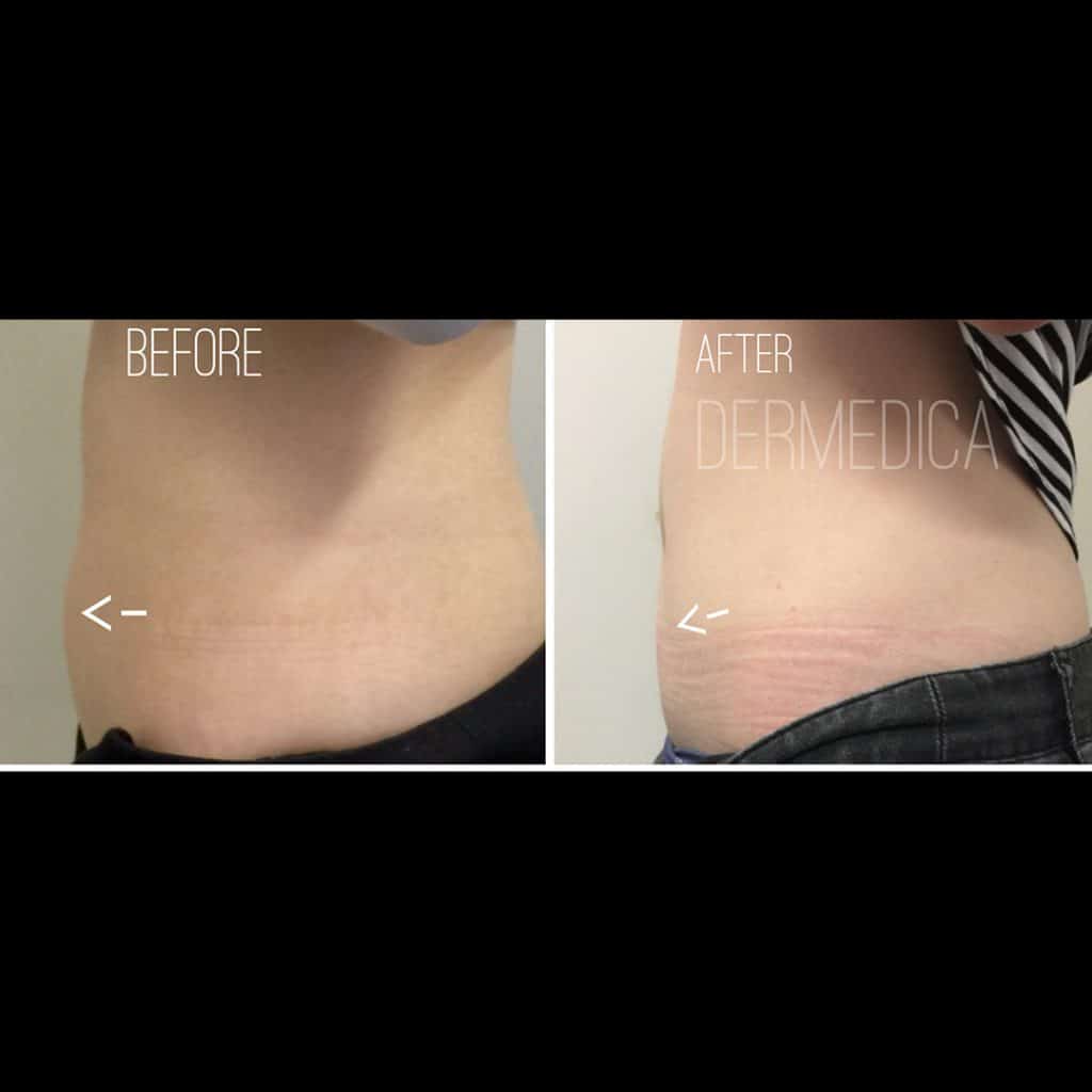 stomach fat removal