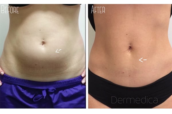 Effective before and after stomach fat view of a woman after Coolsculpting for Abdomen treatment.