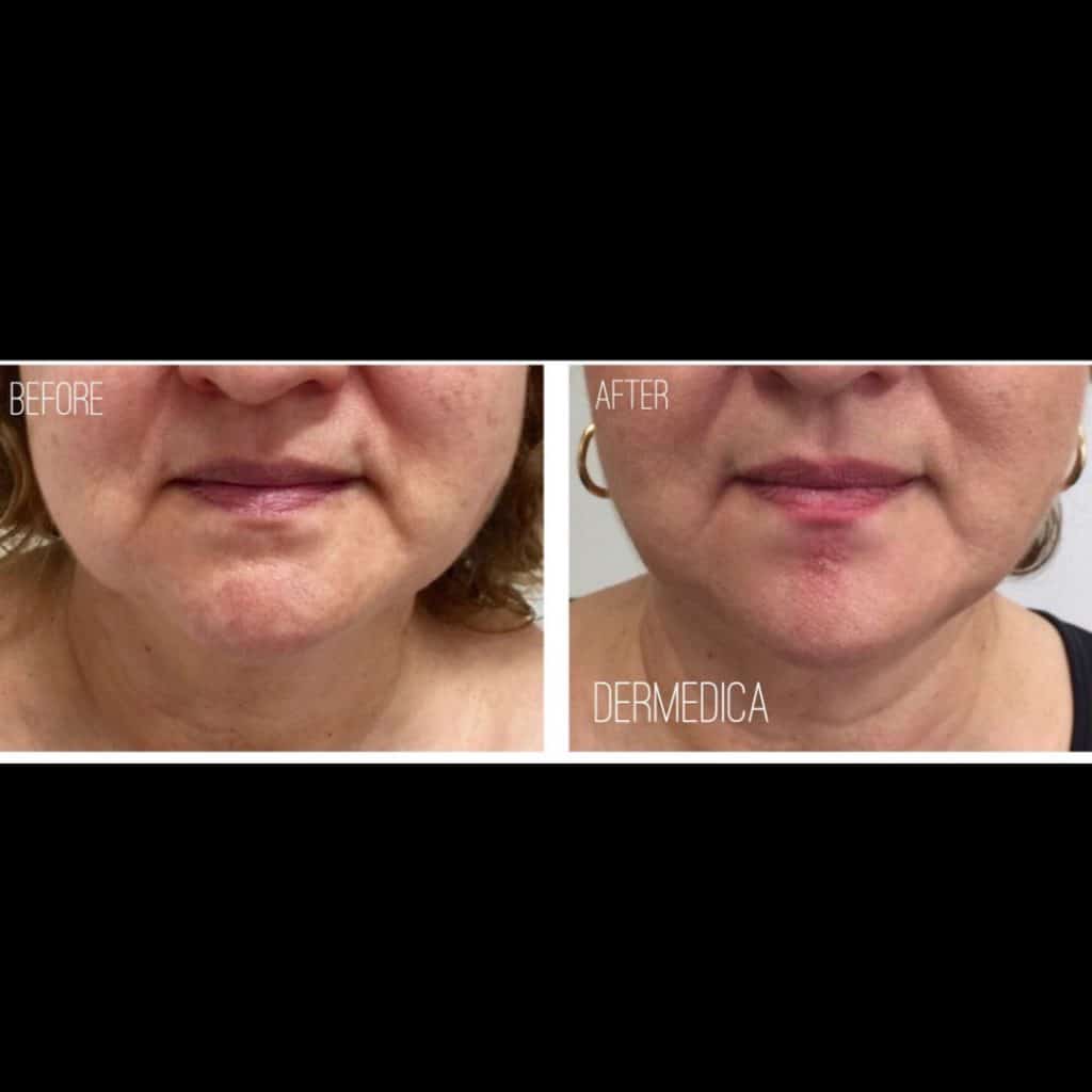Cosmetic Treatment Before and After
