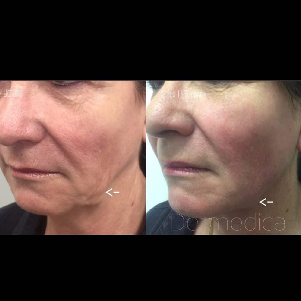 Cosmetic Treatment Before and After