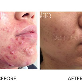 acne and scarring