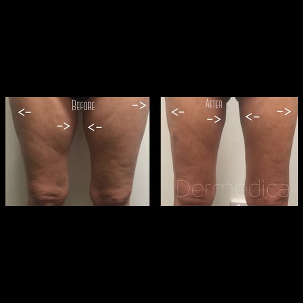 Fat Thighs Before And After Фото база