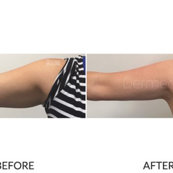 Close-up before and after arm fat of a woman after a fat freezing treatment.
