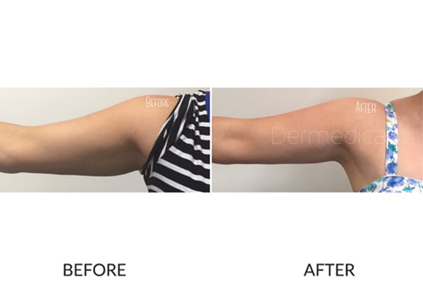 Close-up before and after arm fat of a woman after a fat freezing treatment.
