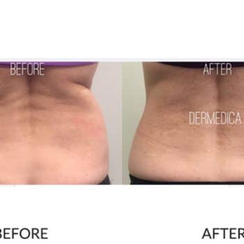 Before and after bra or back fat treatment with Coolsculpting.