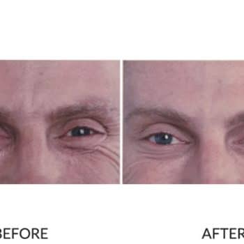 Close-up results of effective anti-wrinkle injections for crow's feet of a man.