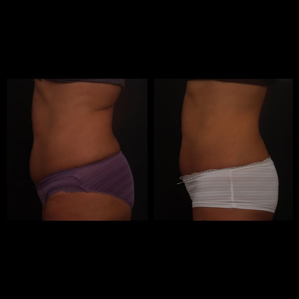 non surgical fat reduction