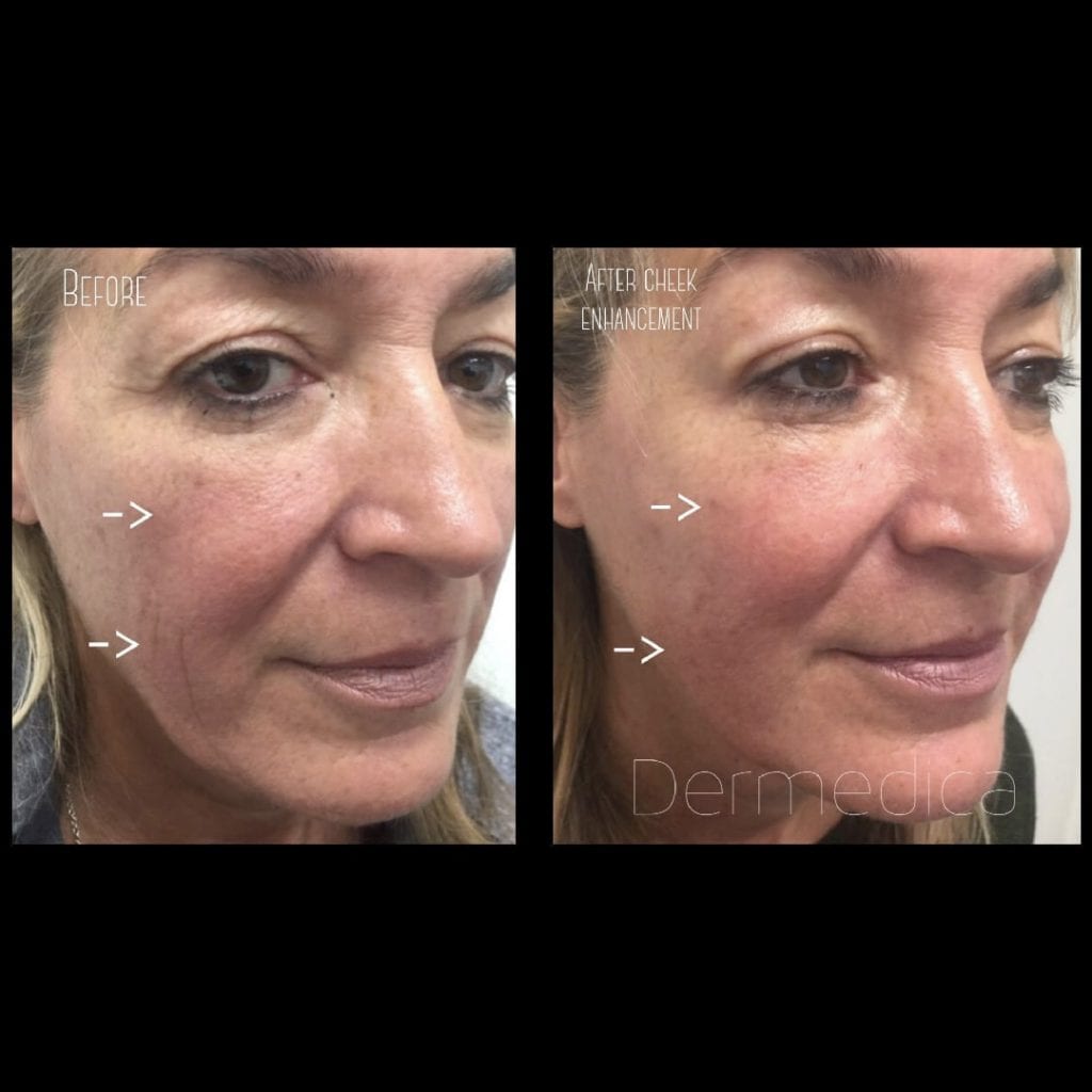 Dermal fillers cheeks before and after