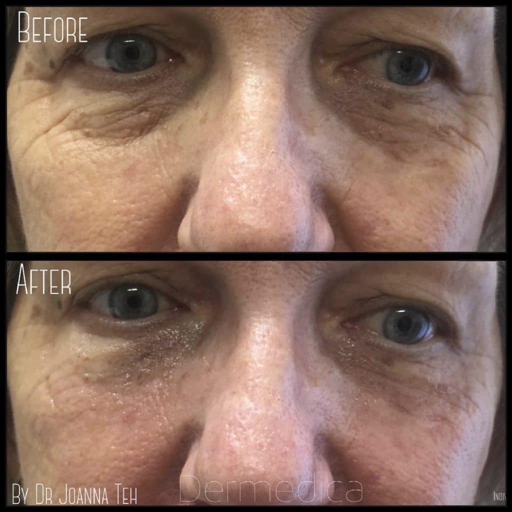 before and after under eye treatment