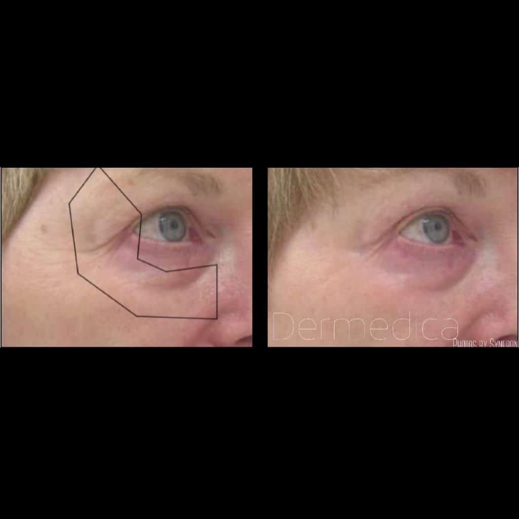 under eye wrinkle treatments