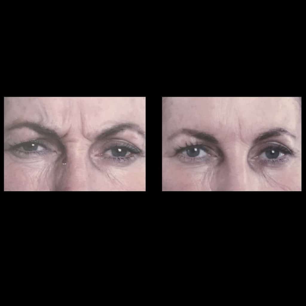 Frown Lines anti-wrinkle injection before and after