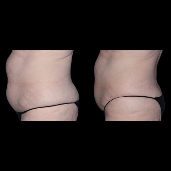 non surgical fat reduction