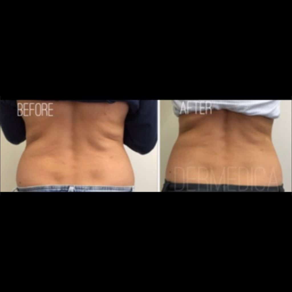 Back Fat Removal