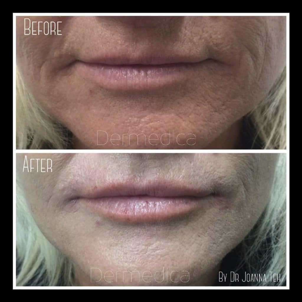 Effective result of a Lips filler treatment of a woman.