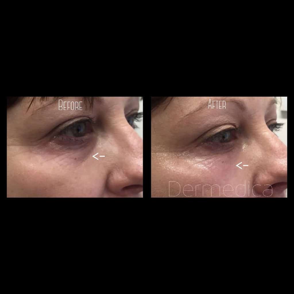 under eye wrinkle treatments