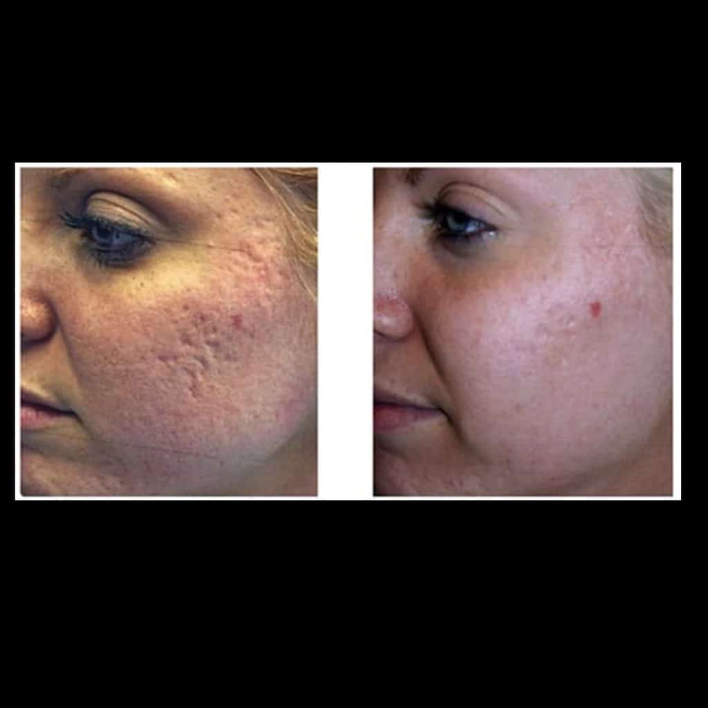 freckle removal perth