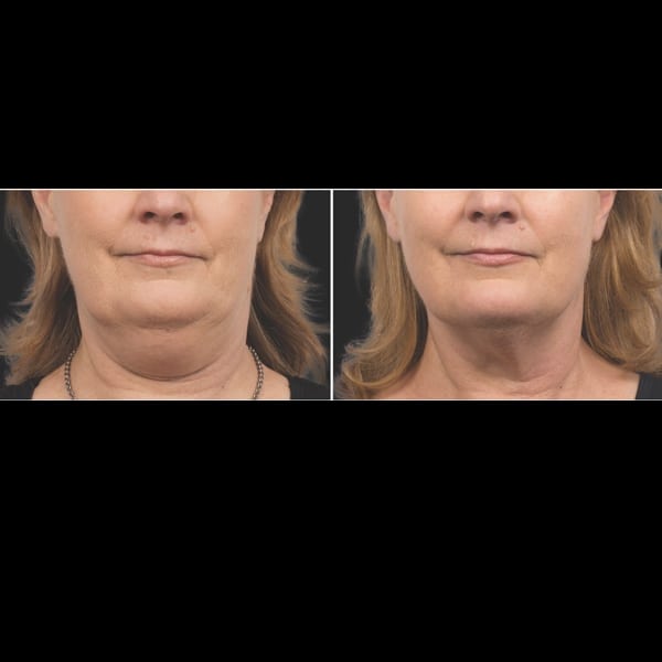 Coolsculpting for double chin, double chin reduction
