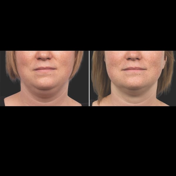 Coolsculpting for double chin, double chin reduction