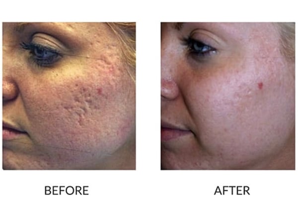 Before and after close-up acne scars view of a patient after a successful Fractional Resurfacing treatment.