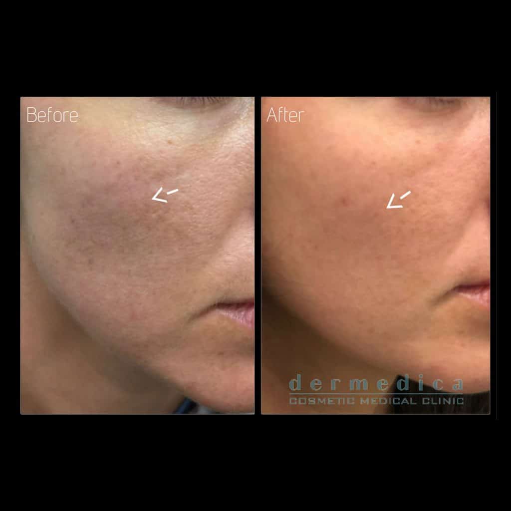 freckle removal perth