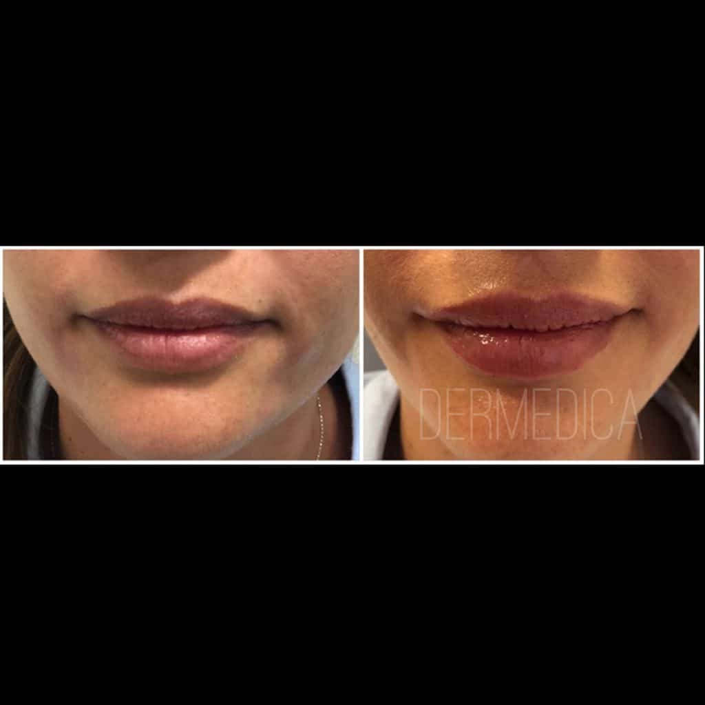 lip enhancement perth