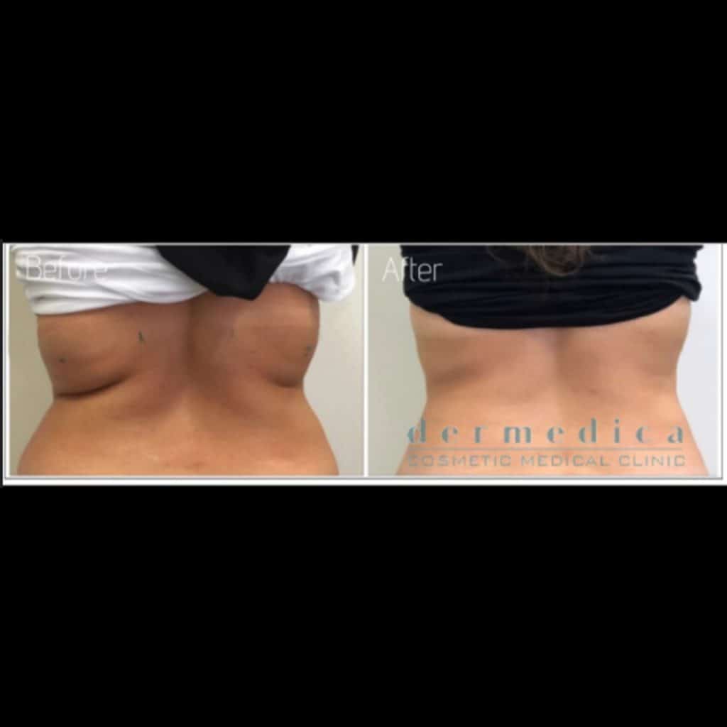 Back Fat Removal