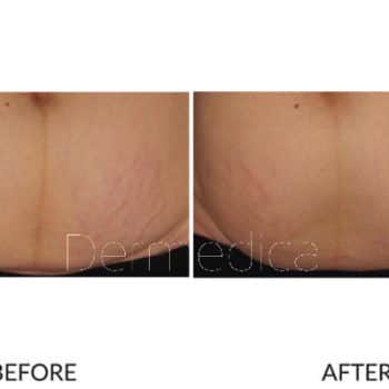 treatment for stretch marks