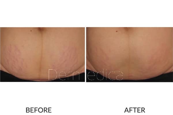 treatment for stretch marks