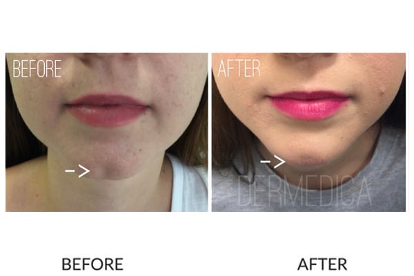 Chin filler effective result before and after.