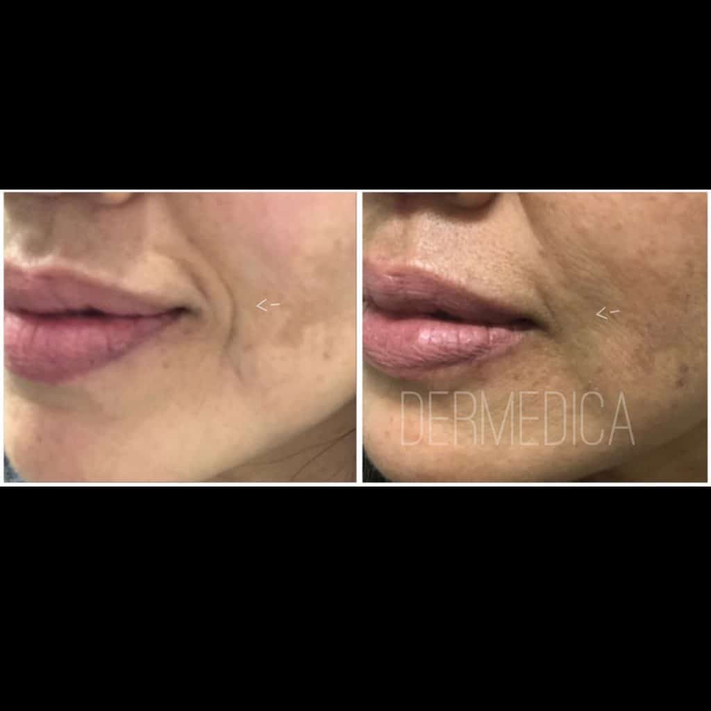 smile lines filler before and after
