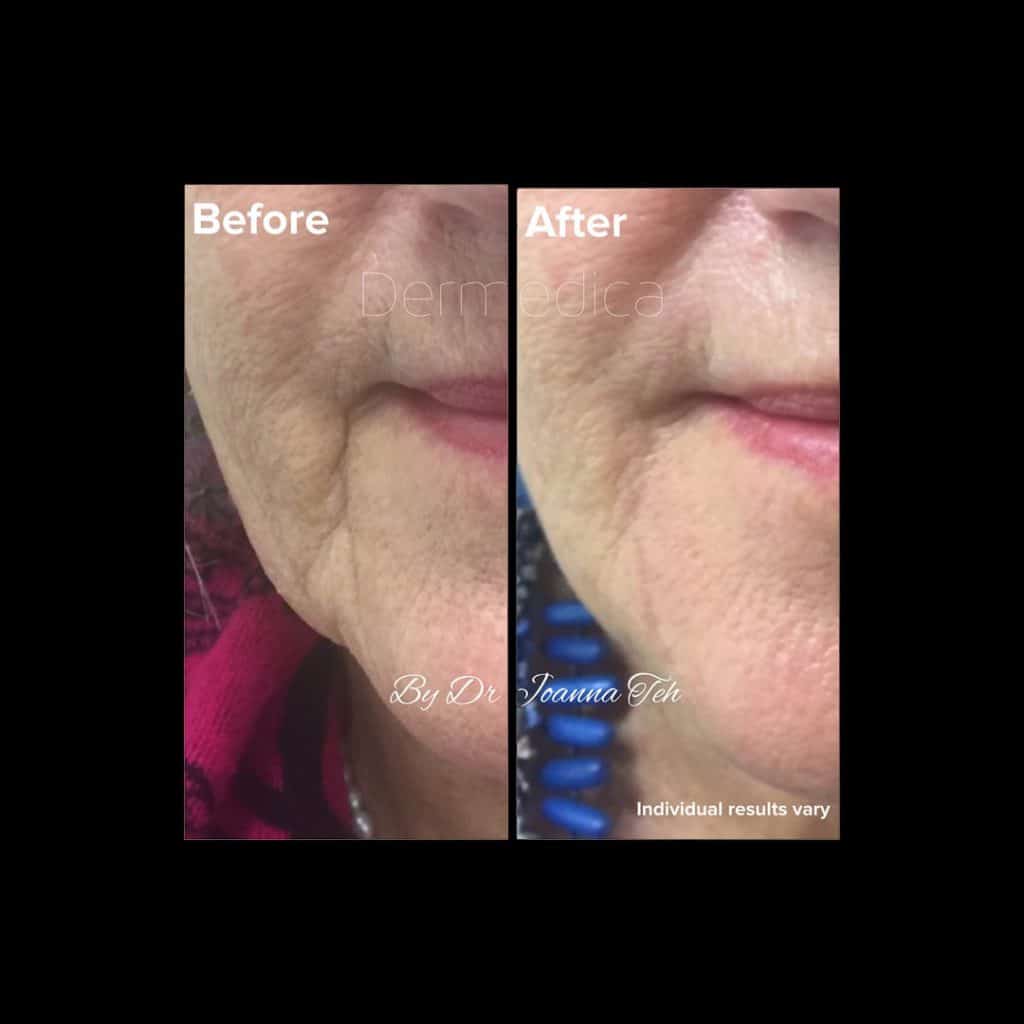 Smile lines filler Before and After