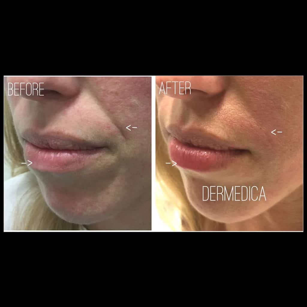 Smile lines filler Before and After