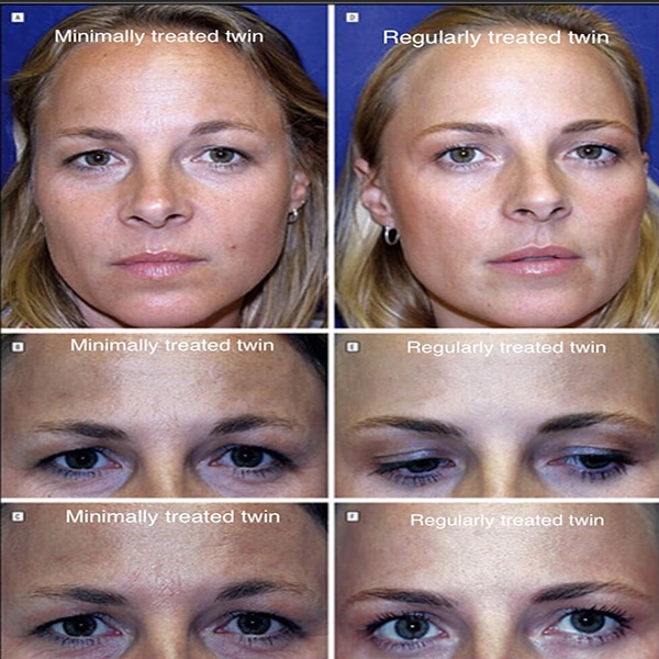 Anti Wrinkle Injections Prevent Wrinkles