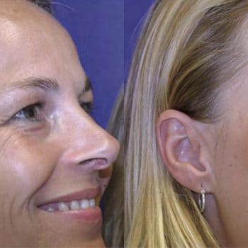 Anti Wrinkle Injections Prevent Wrinkles