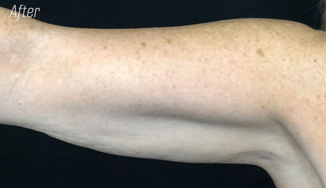 Trusculpt Arm fat reduction, body contouring