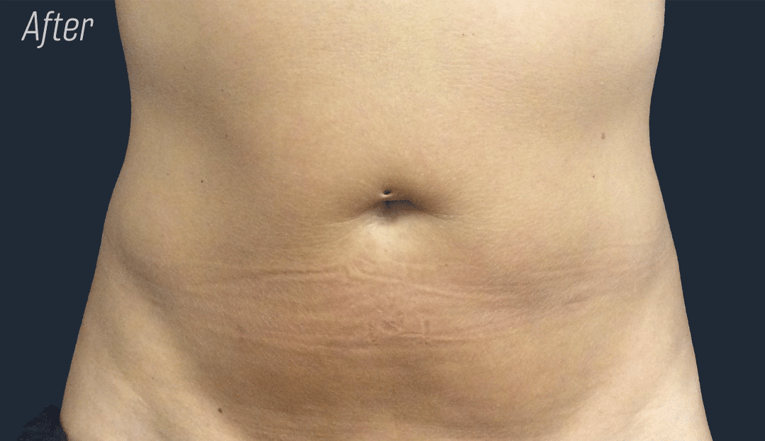 Trusculpt Before and After, Belly fat reduction