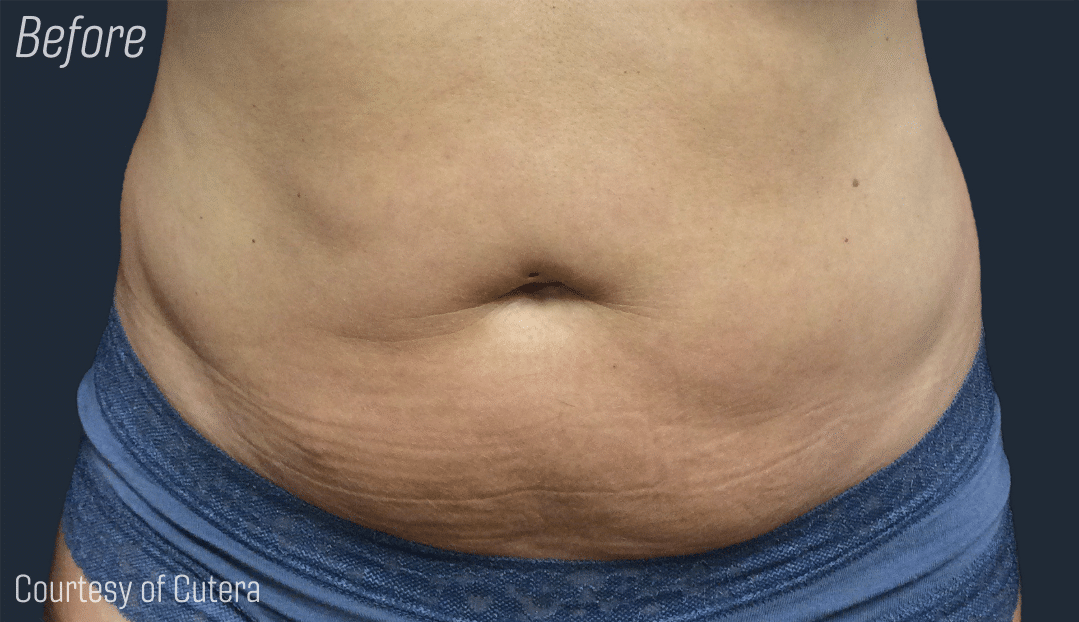 Trusculpt Before and After, Belly fat reduction