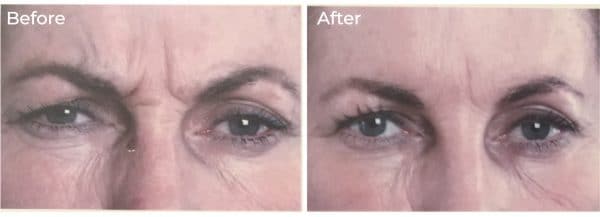 Anti frown before and after