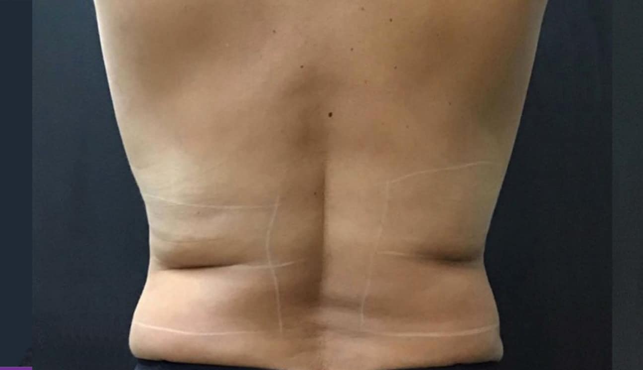 Back fat before trusculpt treatment