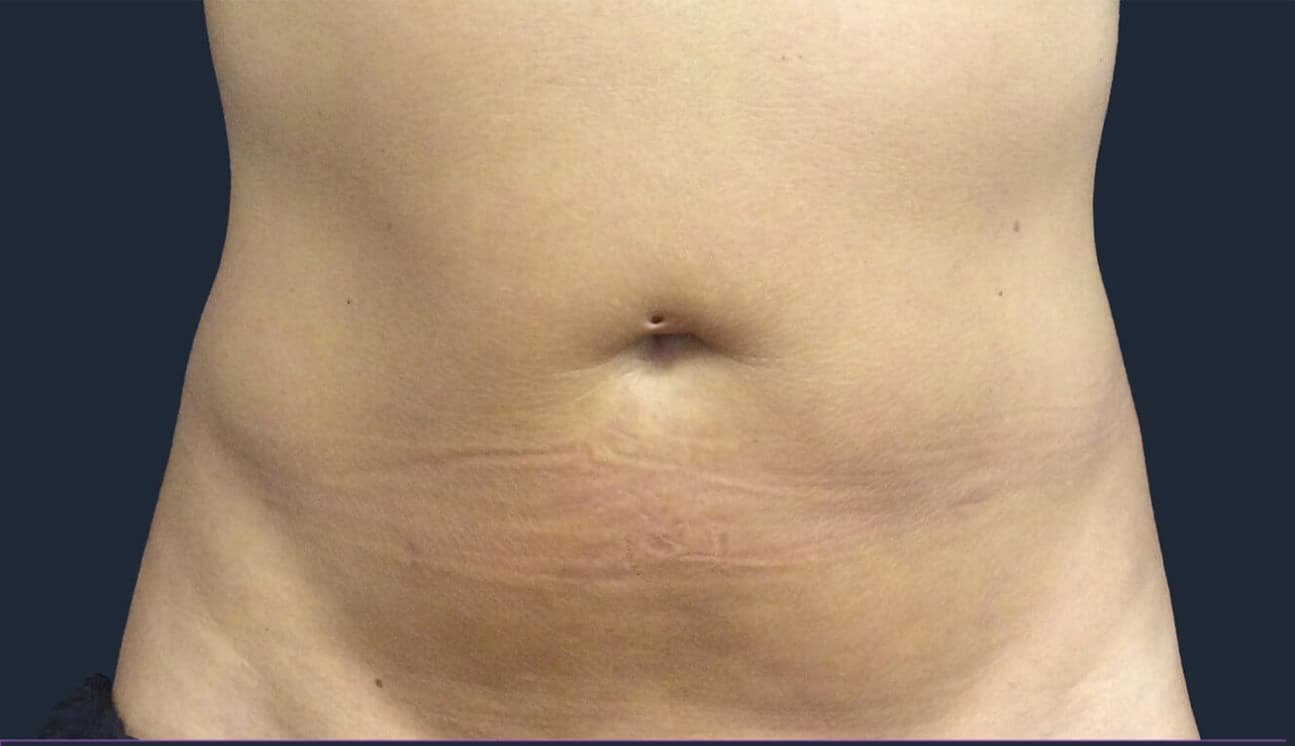 Belly after trusculpt treatment