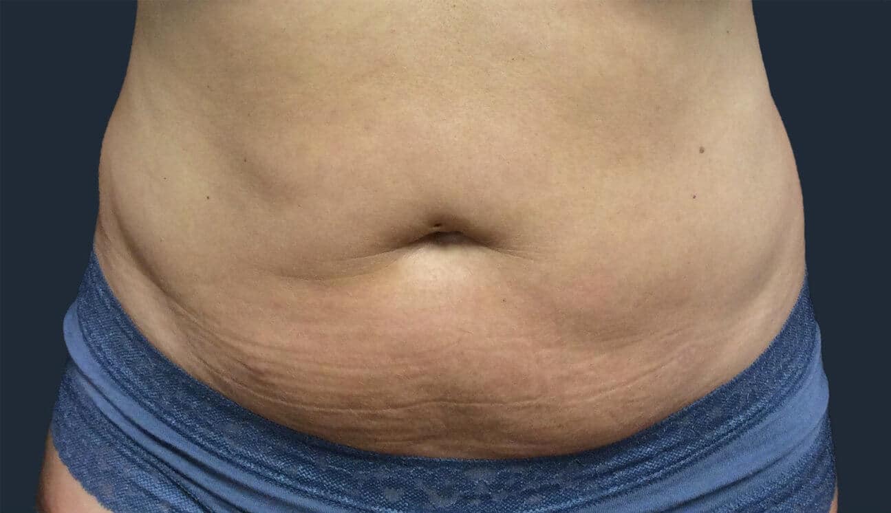 Belly before trusculpt treatment