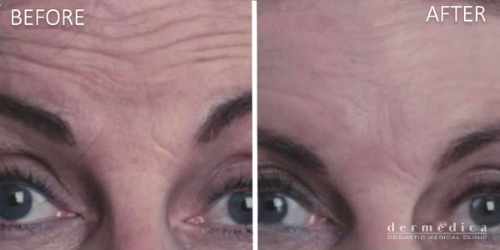 Before and After Anti Wrinkle Injections or Wrinkle Relaxers Treatment in Forehead Lines at Dermedica Perth