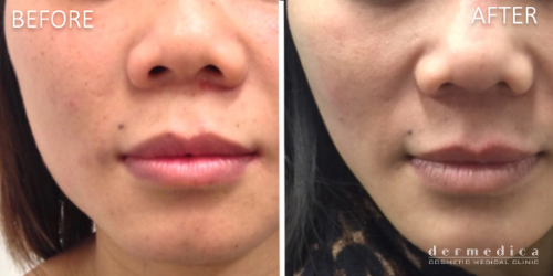 Before and After Jaw Slimming Treatment with Wrinkle Relaxers or Anti Wrinkle Injections at Dermedica Perth