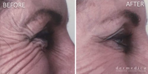 Before and After Anti Wrinkle Injections or Wrinkle Relaxers Treatment in Crows Feet at Dermedica Perth