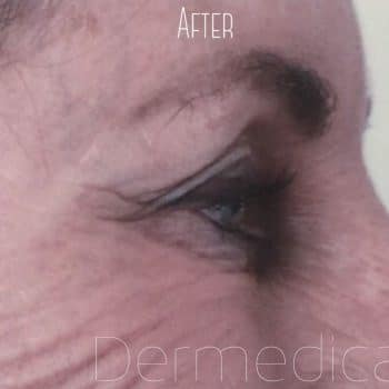 Side view of severe crow's feet after anti wrinkle injections.